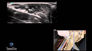 How To Ultrasound Guided Axillary Nerve Block 3D Video [upl. by Ueihtam]