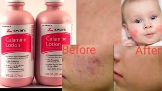 Calamine Lotion 🥰 [upl. by Hayyifas66]