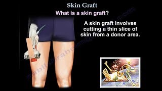 Skin Graft  Everything You Need To Know  Dr Nabil Ebraheim [upl. by Oludoet]