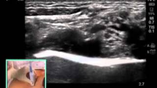 ULTRASOUNDGUIDED SUPRACLAVICULAR NERVE BLOCK [upl. by Willtrude597]