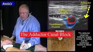 The Adductor canal block [upl. by Fabrin339]