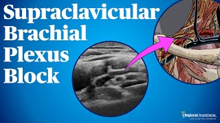 Supraclavicular Brachial Plexus Block [upl. by Aeneg]