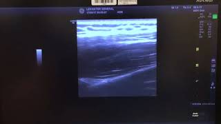 Suprascapular Nerve Block Ultrasound Guided [upl. by Clere341]