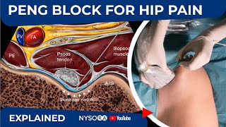 PENG BLOCK FOR HIP PAIN  NYSORAs Regional Anesthesia Clinical Cases [upl. by Atinra]